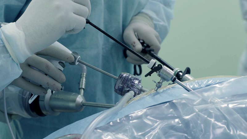 Laparascopic Surgery Laparascopic Surgery